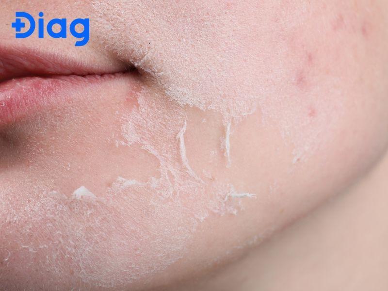 Da khô là một trong những nguyên nhân phổ biến gây ngứa khắp người mà không nổi mẩn đỏ.