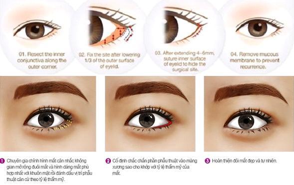 Phẫu thuật mắt to tại Bệnh viện Thái Thượng Hoàng được xem là giải pháp