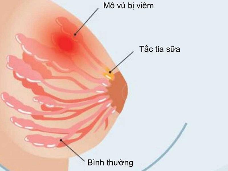 Bị tắc tia sữa khiến bầu ngực mẹ nóng ran, nổi các cục nhỏ gây đau
