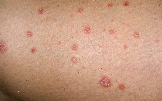 Hình ảnh bệnh lậu ở trên da
