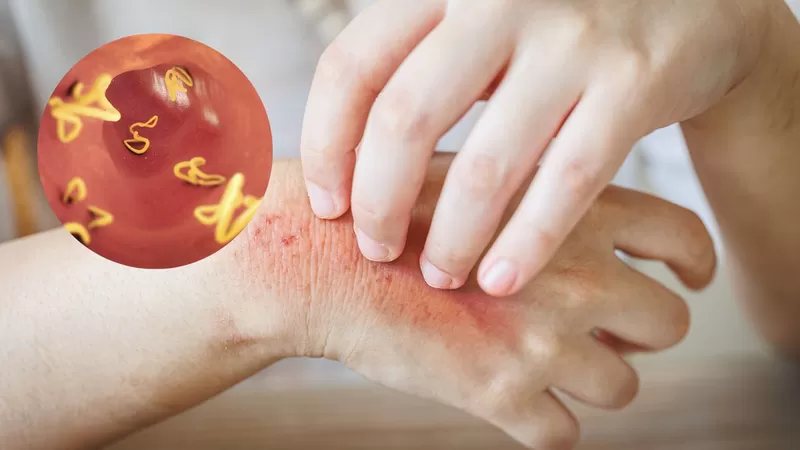 Hình ảnh con sán chó: mẩn đỏ và ngứa da điển hình do Toxocara