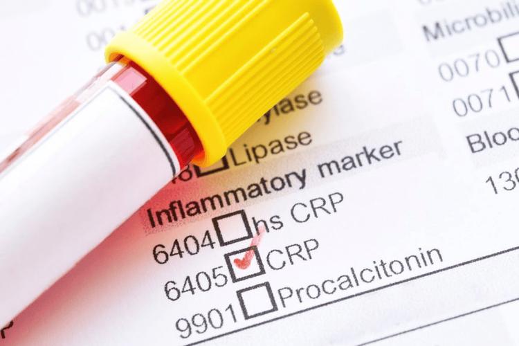 Xét nghiệm hs-CRP có nhiều lợi cho việc dự đoán nguy cơ bệnh tim mạch