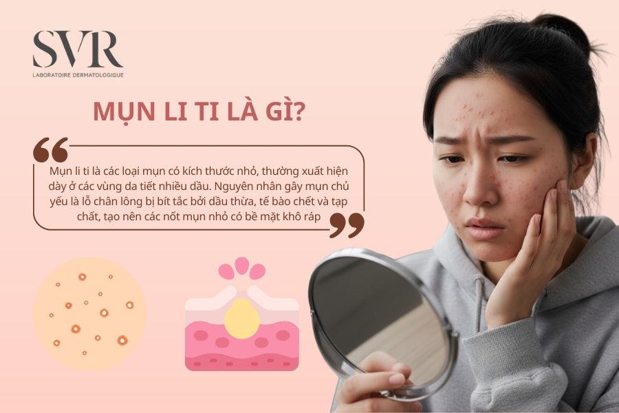 Mụn li ti là gì?
