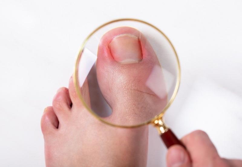 Móng chân mọc ngược sẽ khiến phần móng của bệnh nhân bị sưng đau khó chịu
