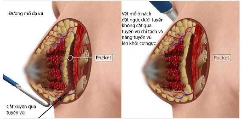 đặt túi ngực trên cơ ngực lớn