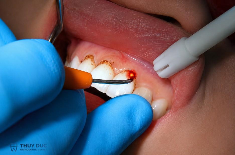 1. Cắt lợi bằng laser là gì? 1