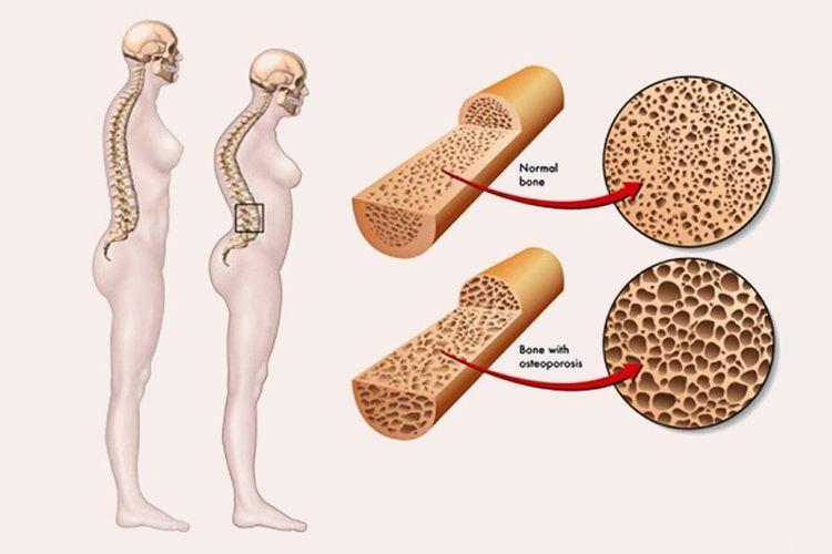 Magie thấp là một yếu tố nguy cơ gây bệnh loãng xương