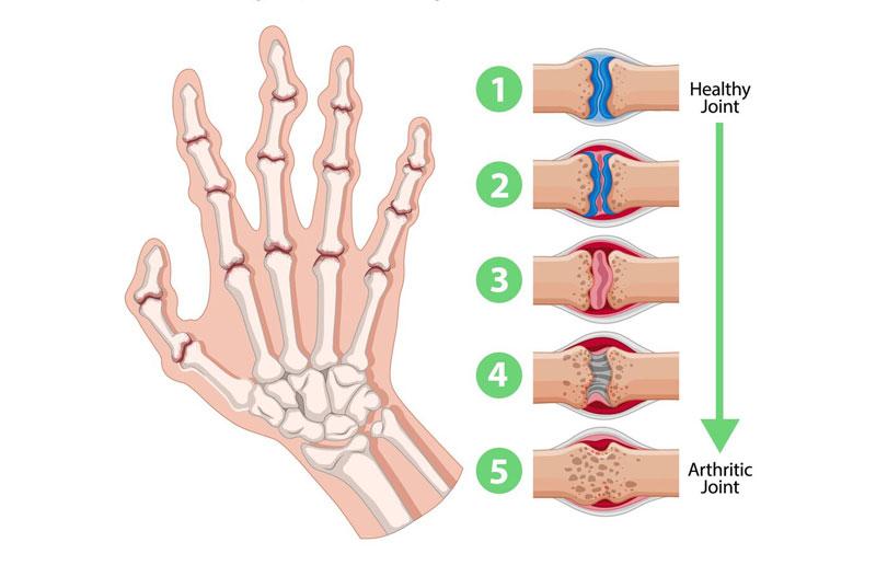Sưng khớp ngón tay là kết quả của bệnh lý viêm khớp ngón tay