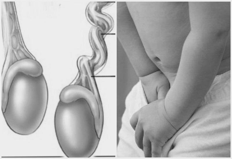 Tinh hoàn chảy xệ có thể xuất phát từ nhiều nguyên nhân khác nhau gây nên một số bất tiện cho cuộc sống nam giới