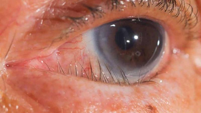 Lông xiêu là gì? Nguyên nhân và cách điều trị 1